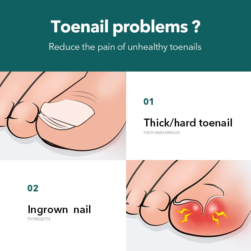 MG Ingrown Toe Nail Clipper
